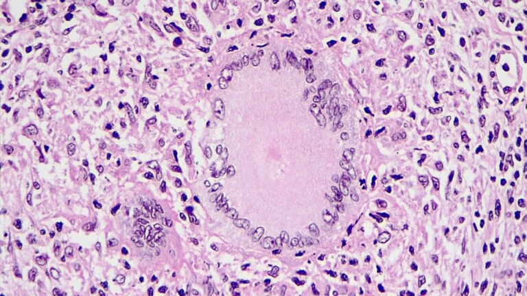 This state is facing the largest tuberculosis outbreak in US history
